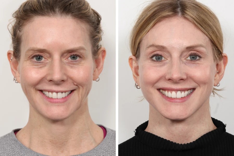 Best Aesthetic Clinics in Dubai for Thread Lift Non-Invasive Lifting Care