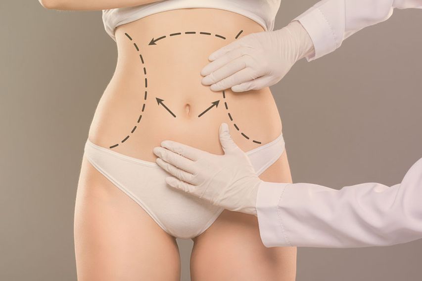 Abdominoplasty Dubai