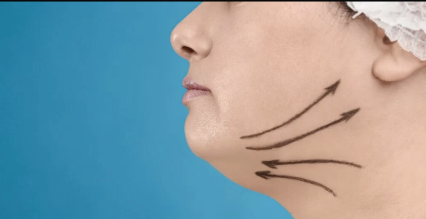 Double Chin Liposuction In Dubai