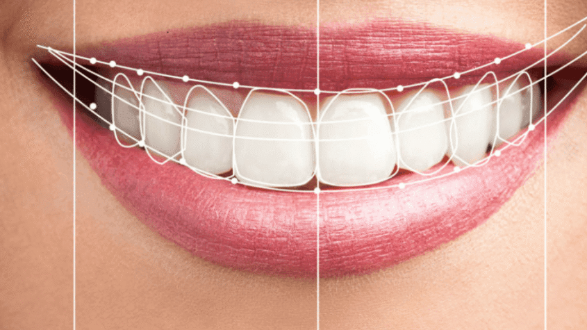 Hollywood Smile in Dubai