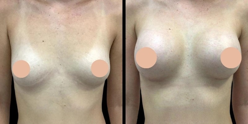 Innovative Techniques Used by the Best Doctors in Dubai for Breast Augmentation