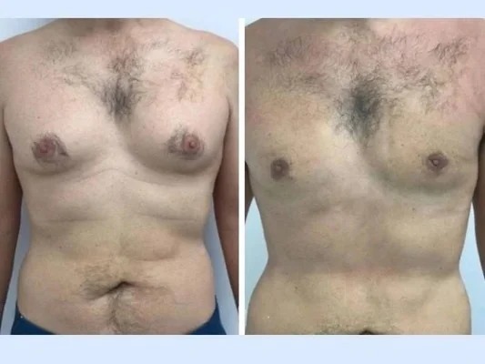 Best Doctors in Dubai for Gynecomastia: Dealing With Emotional Impact